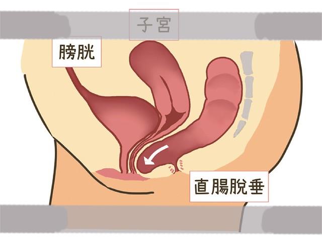 阴道后壁(直肠)脱垂